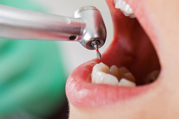 Best Emergency Dentist for Knocked-Out Tooth in Issaquah, WA